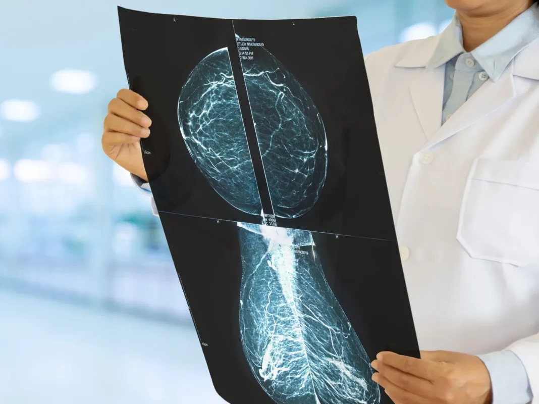 Ontario-Lowers-The-Age-For-Regular-Breast-Cancer-Screening-to-40